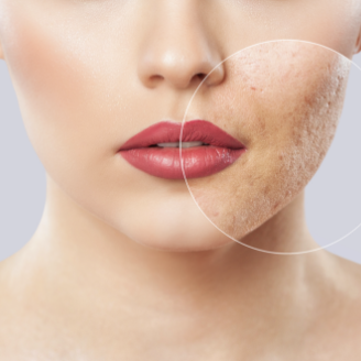 Leia mais sobre o artigo Correção de Cicatrizes de acne